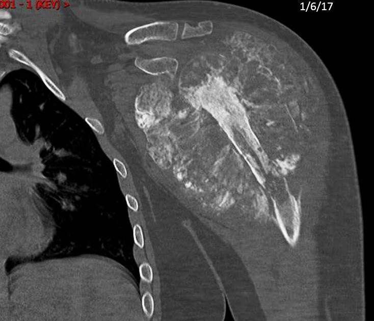 Figure 3 for case Osteosarcoma ( RID4010 ) with a pathologic fracture